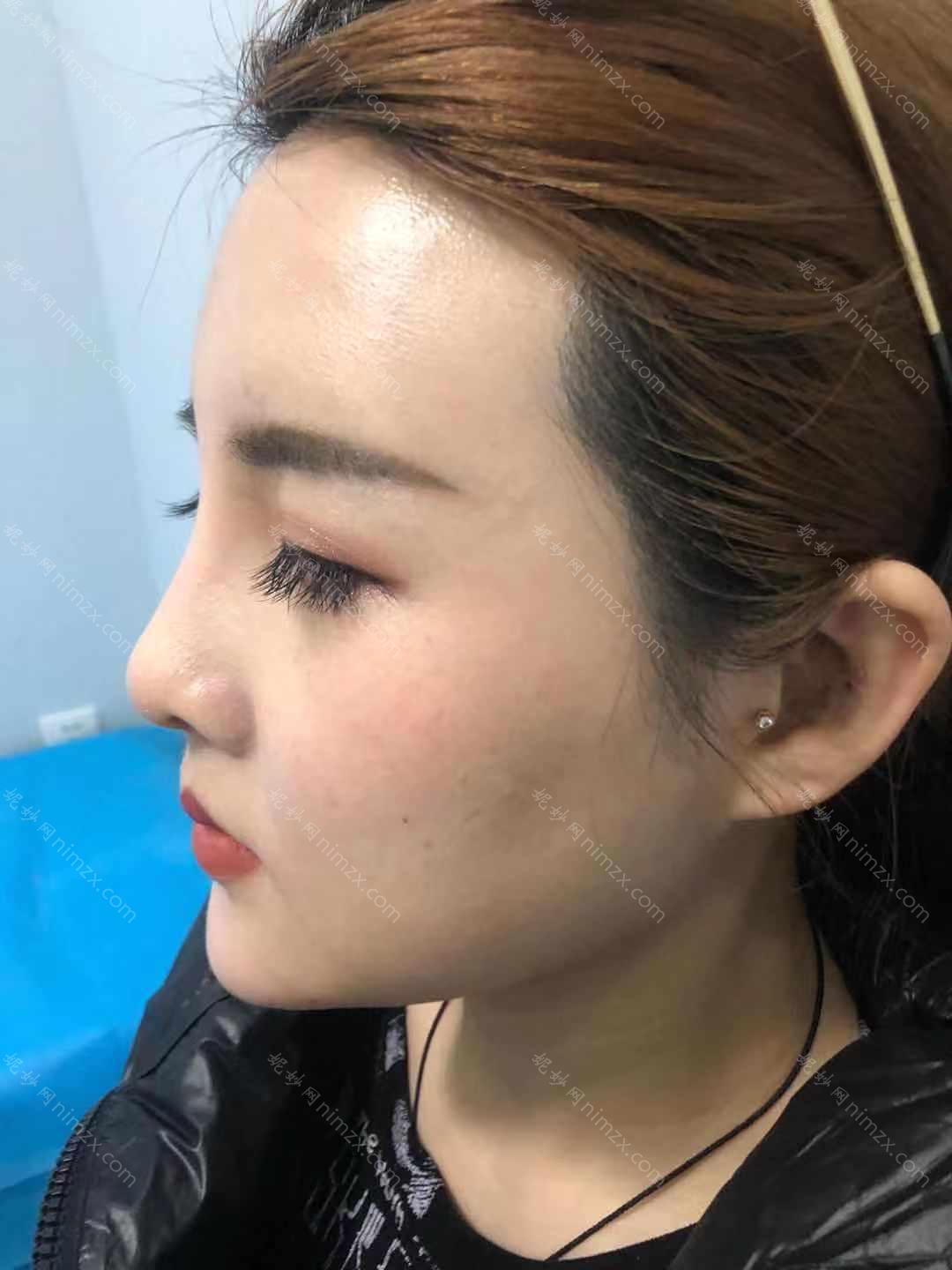 广东哪家医院做线雕隆鼻手术较好？排名前四权威医美口碑盘点_含手术价格查询！