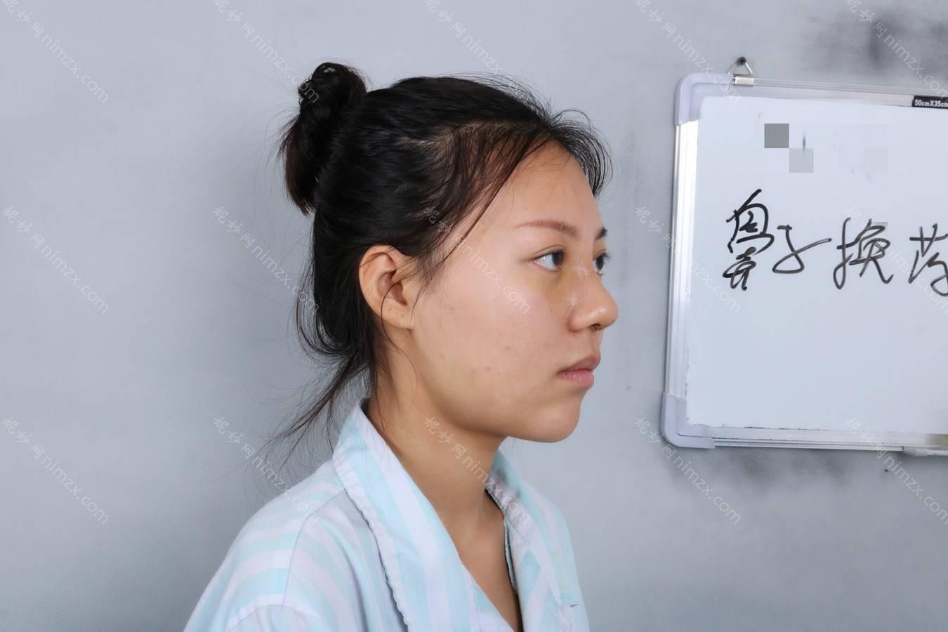 广东哪家医院做线雕隆鼻手术较好？排名前四权威医美口碑盘点_含手术价格查询！