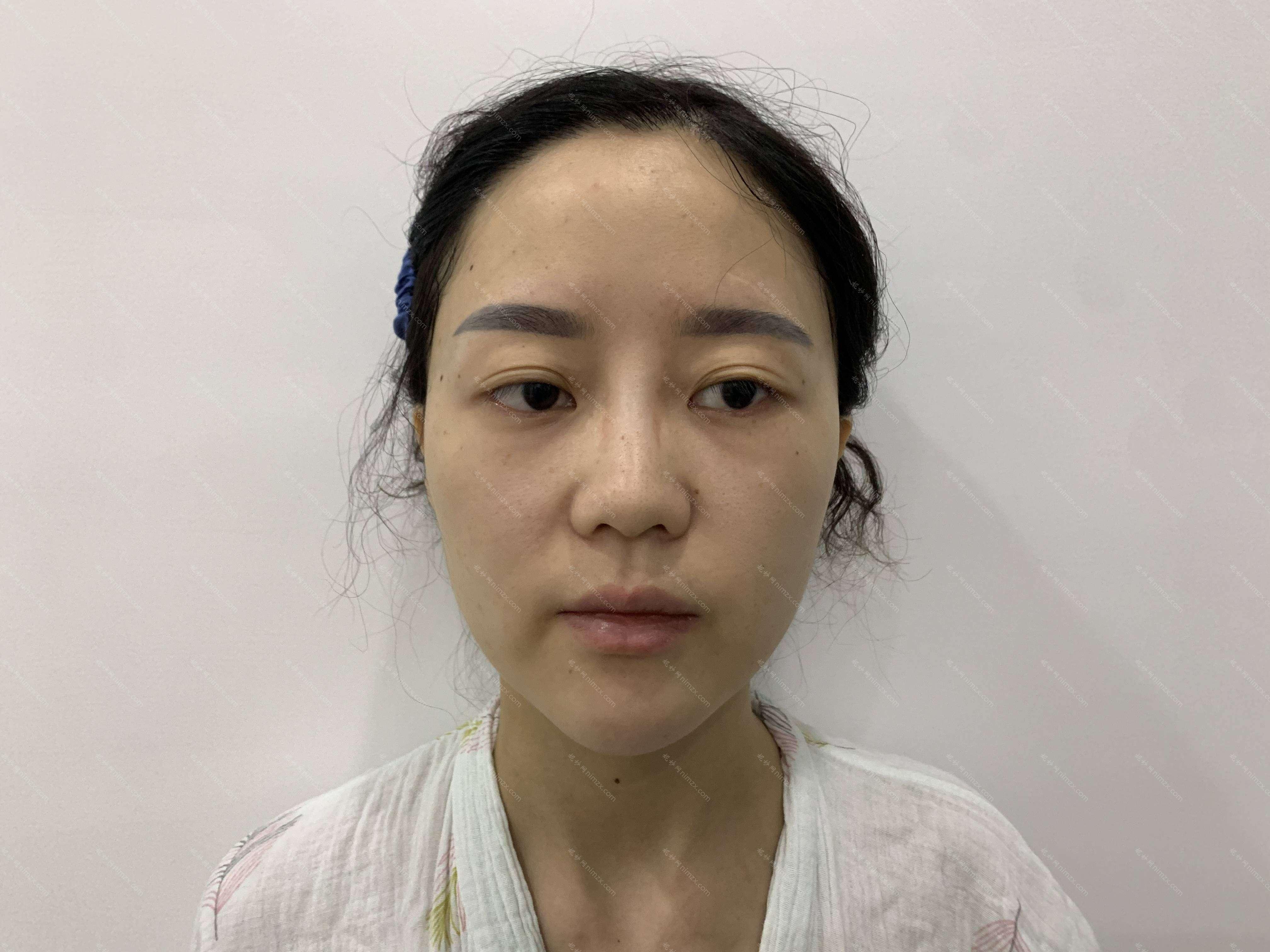 广东哪家医院做线雕隆鼻手术较好？排名前四权威医美口碑盘点_含手术价格查询！