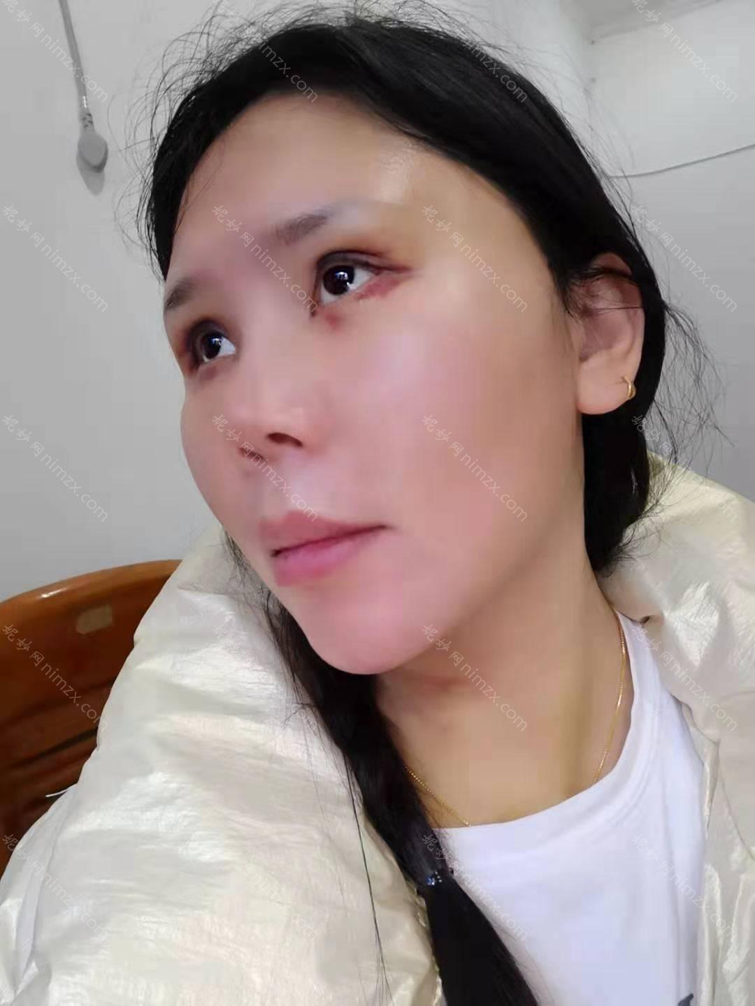 天津哪家医院做瘦脸*较专业？排名榜整理5位医院大咖!华美、天津市宝坻区中医医院、天津华山医院等任选！