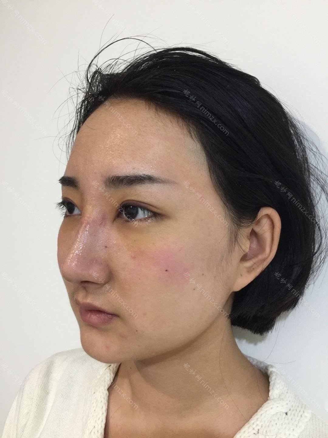 广东哪家医院做驼峰鼻矫正好看？南海幼真肤、启研、广州荔湾区第二人民医院等实力在线比较!！