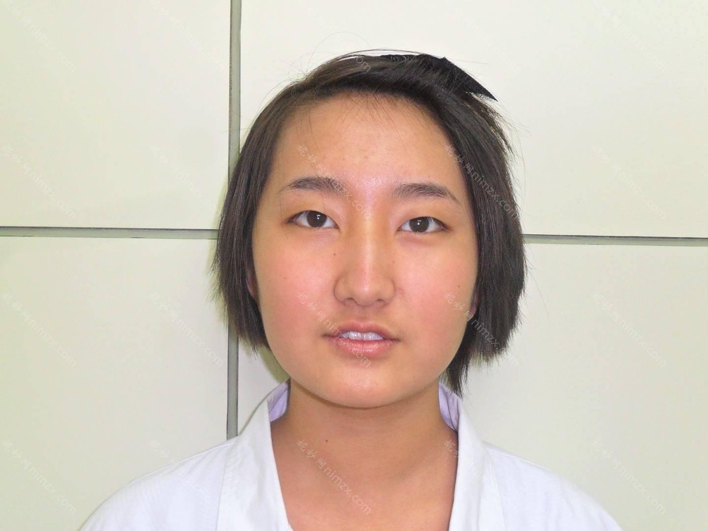 广东哪家医院做驼峰鼻矫正好看？南海幼真肤、启研、广州荔湾区第二人民医院等实力在线比较!！