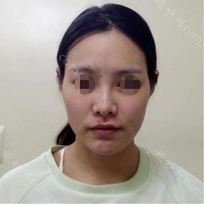 济南海峡美容整形医院徐永脂肪填充怎么样
