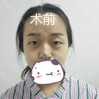 济南海峡医疗美容整形医院逄宝峰双眼皮做得好吗