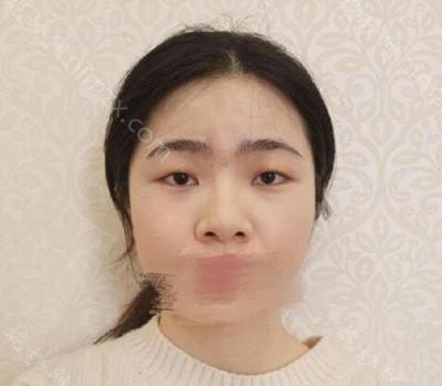 昆明梦想医疗美容整形医院张燕雄做的鼻子怎么样