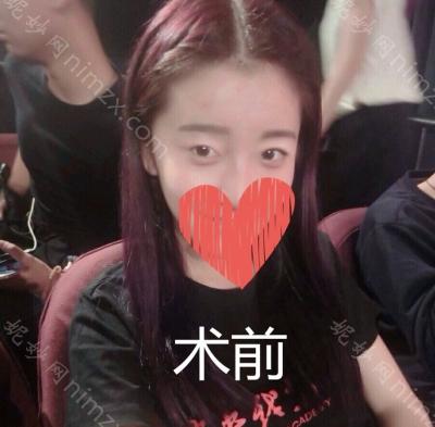 昆明梦想整形美容医院李成龙双眼皮怎么样