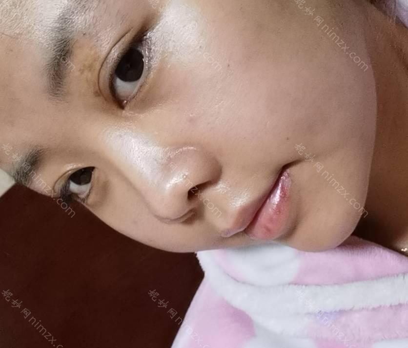 广东哪家医院做假体垫鼻基底正规？排名榜整理5位医院大咖!高潮生、南方医科大学附属何贤纪念医院、瞬丽徒手等任选！