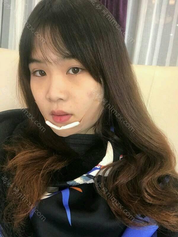天津哪家医院做玻尿酸丰下巴比较靠谱？当属天津市宝坻区林亭口医院、美高美辰、华中这三家!价格(案例)盘点！