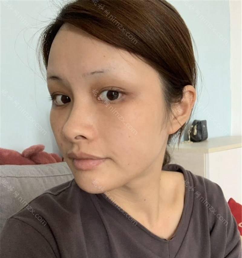 广东哪家医院做去黑眼圈效果比价好？盘点前三排行榜!中南、广大微创、艾睿雅都在内!！