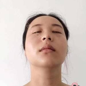 广东哪家医院做眶隔释放去眼袋手术较好？排行榜医院齐聚_臻希美、名优等一一公布口碑!！