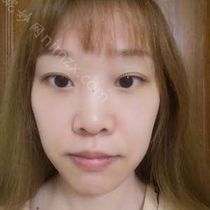 广东哪家医院做眶隔释放去眼袋手术较好？排行榜医院齐聚_臻希美、名优等一一公布口碑!！