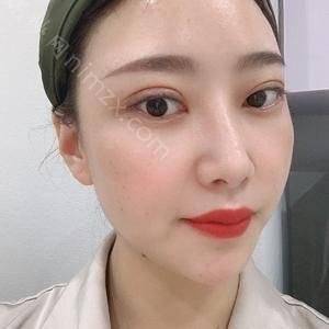 广东哪家医院做眶隔释放去眼袋手术较好？排行榜医院齐聚_臻希美、名优等一一公布口碑!！