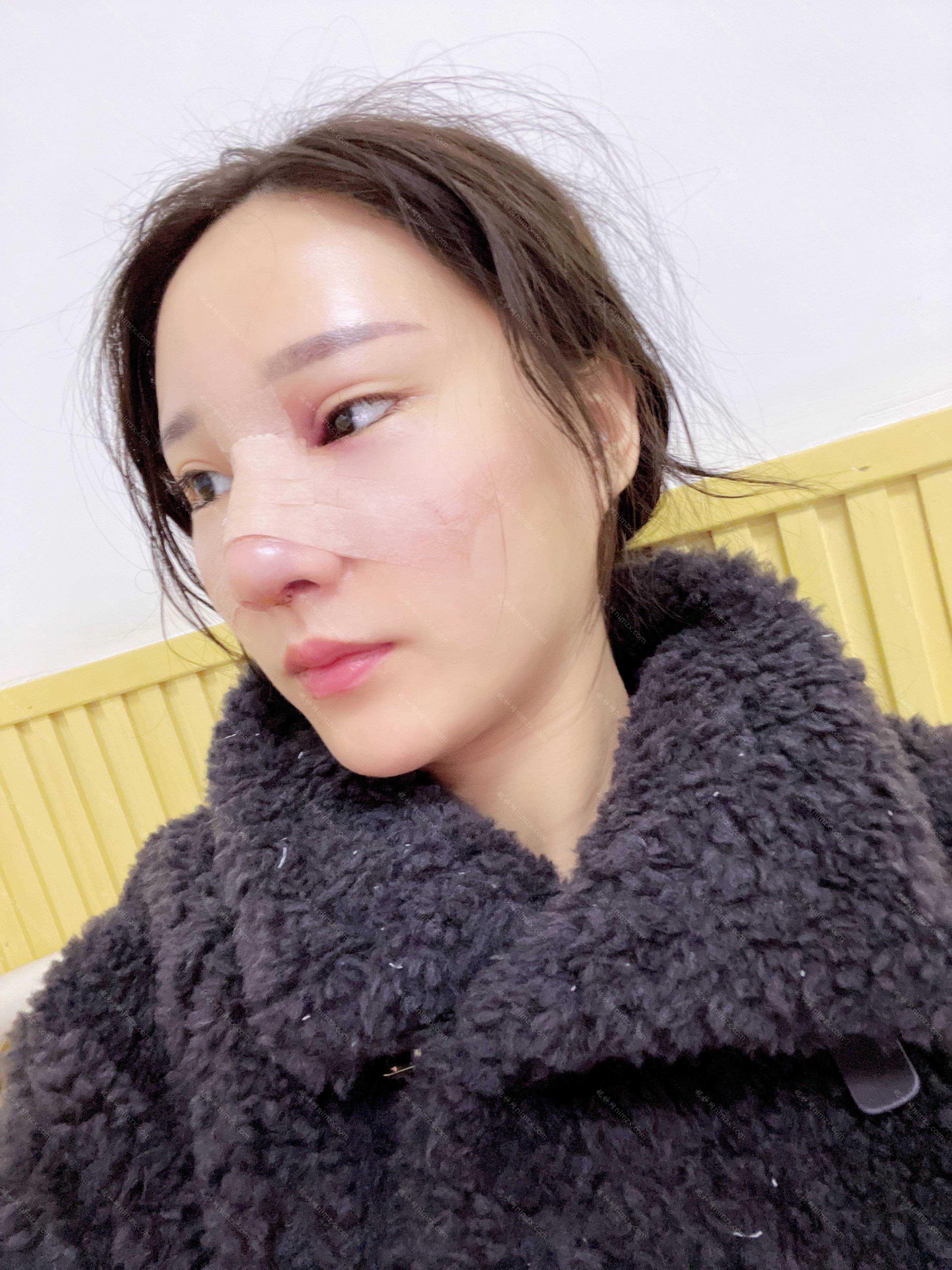 广东哪家医院做假体垫鼻基底正规？排名榜整理5位医院大咖!高潮生、南方医科大学附属何贤纪念医院、瞬丽徒手等任选！