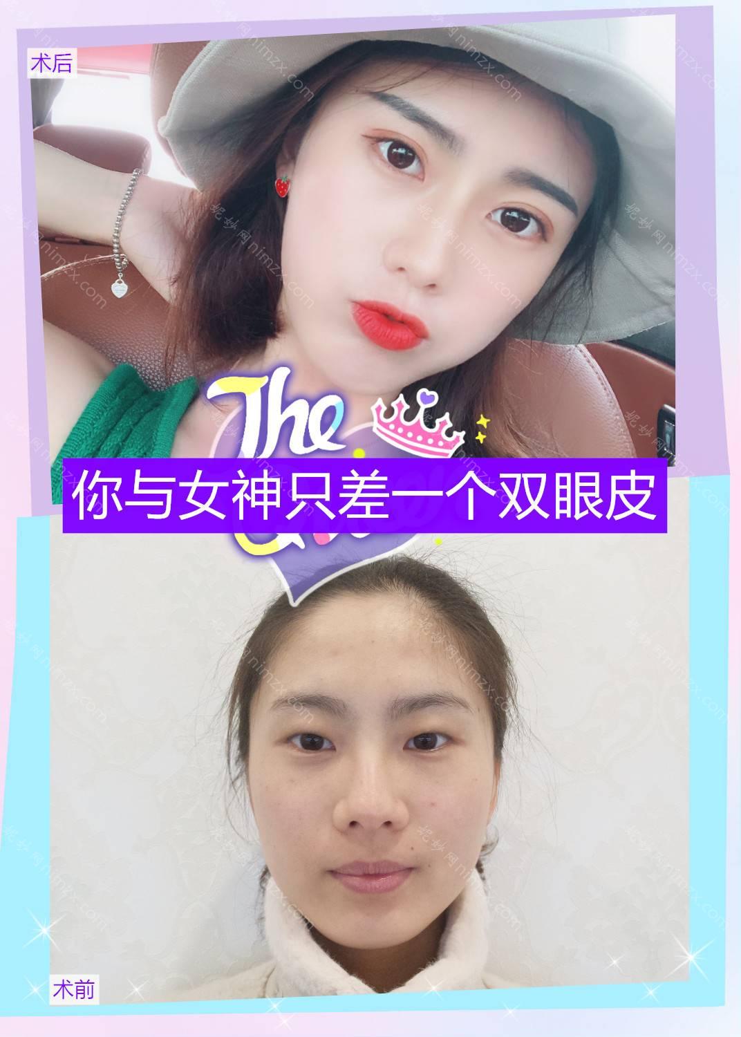 广东哪家医院做硅胶隆鼻效果好？排名榜整理5位医院大咖!AMB澳美、威利斯、雍禾美度等任选！