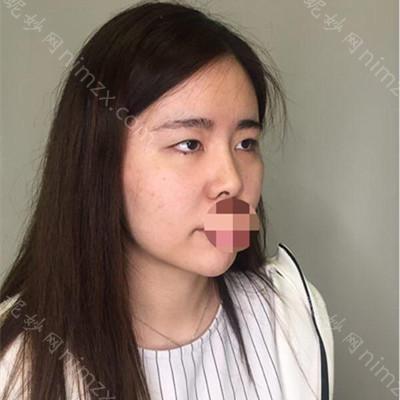 云南华美美莱美容医院夏国兴双眼皮怎么样