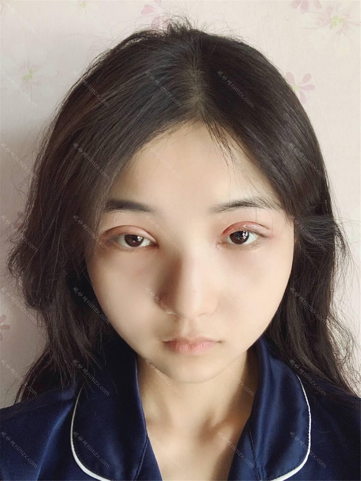 广东哪家医院做去黑眼圈效果比价好？盘点前三排行榜!中南、广大微创、艾睿雅都在内!！
