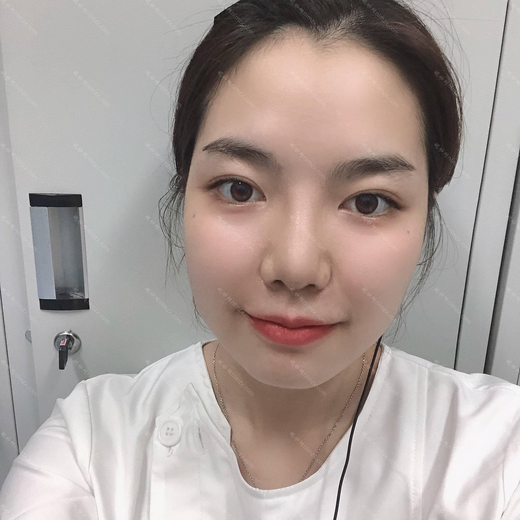 广东哪家医院做超体隆鼻正规？当属炫美、南方医科大学附属何贤纪念医院、药科大学附属第三医院皮肤疤痕科这三家!价格(案例)盘