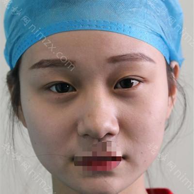 云南华美美莱美容医院美莱李韬双眼皮做得好吗