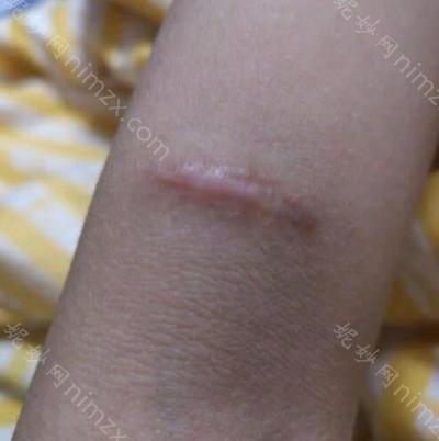 云南华美美莱美容医院俞满昌祛疤痕案例