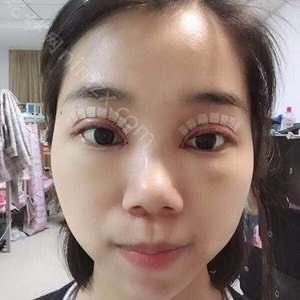广东哪家医院做切开法双眼皮比较好？排行名单有壹美健、南海区长安较好人民医院-、艾美等!价格收费均价一览!！