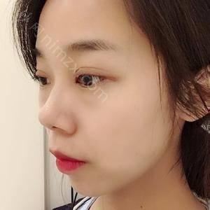 广东哪家医院做切开法双眼皮比较好？排行名单有壹美健、南海区长安较好人民医院-、艾美等!价格收费均价一览!！