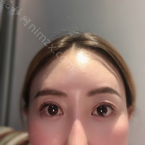 广东哪家医院做韩式三点双眼皮手术好？排名前四权威医美口碑盘点_含手术价格查询！