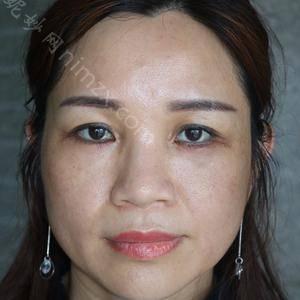 国内祛眼袋整形价格表_2021年较新祛眼袋多少钱