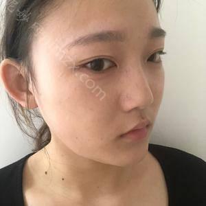 衡阳爱思特整形医疗美容医院李比医生做瘦脸技术怎么样？