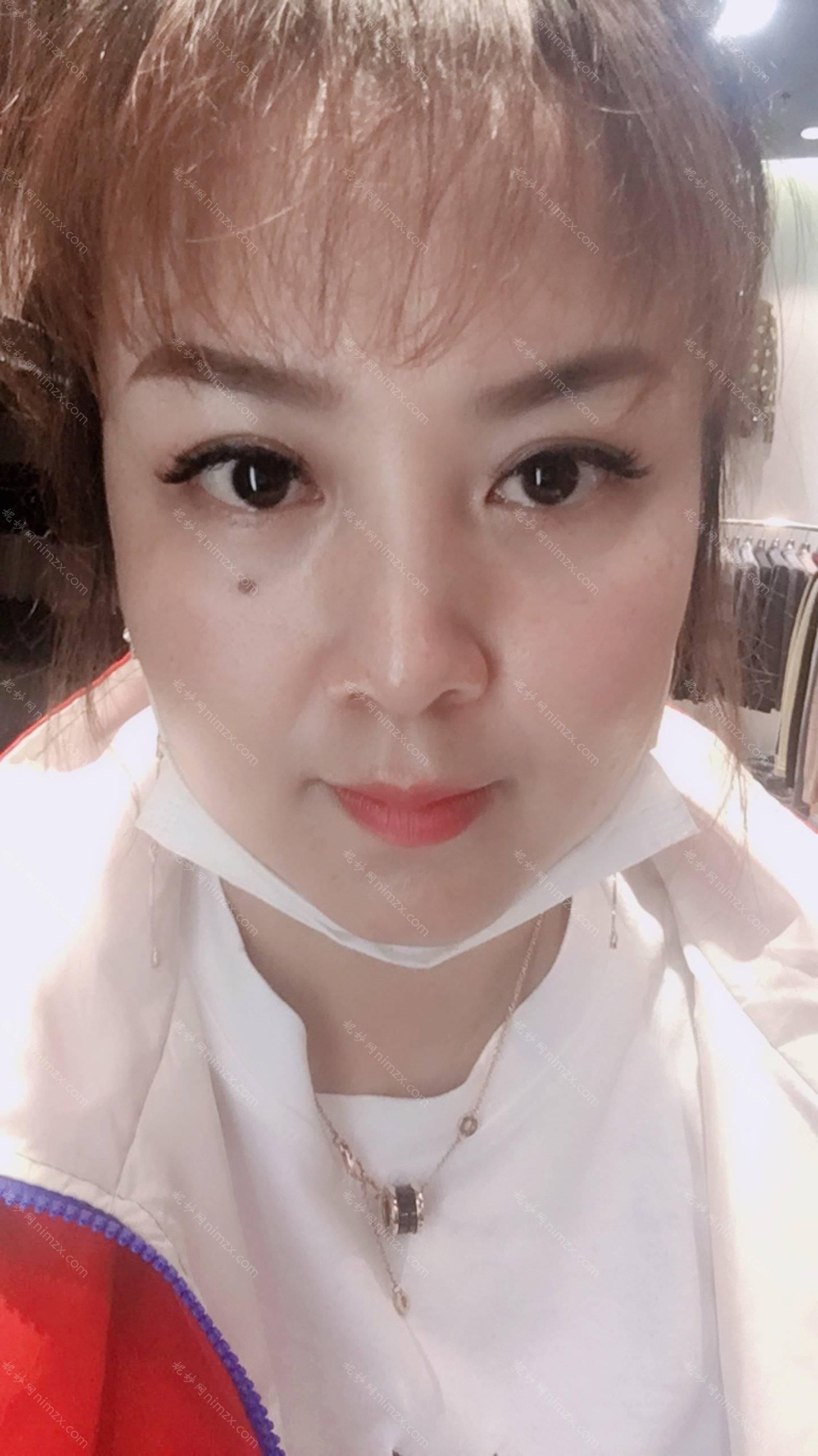 依萱绮医学美容蔡震医生做上眼睑去脂 靠谱吗？