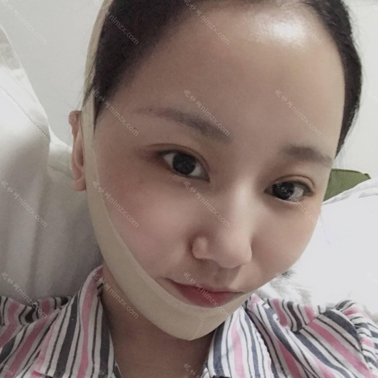 依萱绮医学美容卢帆医生做面部提升怎么样？
