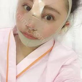 苏州太仓华美俪人整形美容门诊部连凯峰医生做鼻综合整形怎么样？