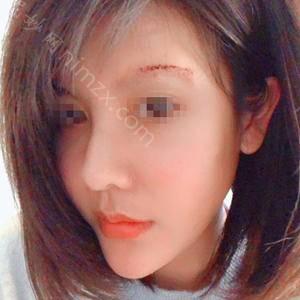 长沙爱思特整形医疗美容医院杨千里医生做开眼角修复好吗？