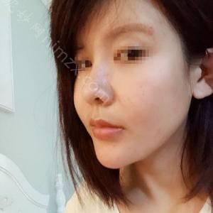 长沙爱思特整形医疗美容医院杨千里医生做开眼角修复好吗？
