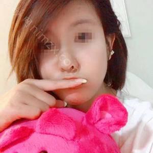 长沙爱思特整形医疗美容医院王谊医生做缩鼻 靠谱吗？