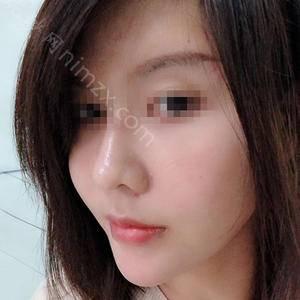长沙爱思特整形医疗美容医院王谊医生做缩鼻 靠谱吗？