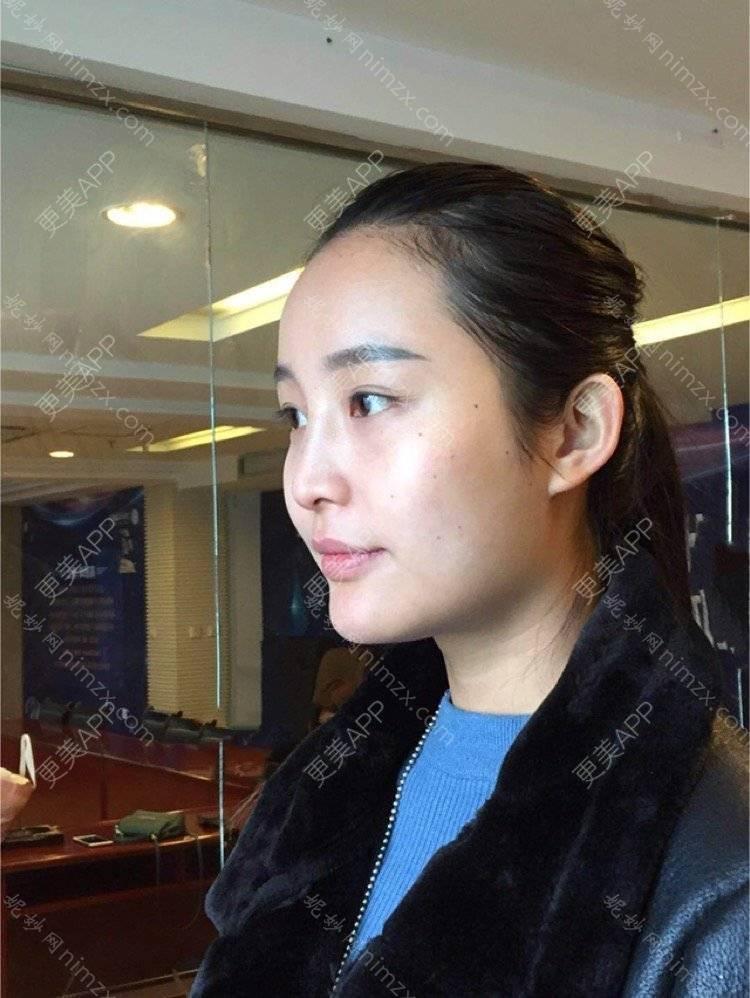 肇庆哪家医院做线雕隆鼻好？2021排行榜前五这几家都有资质_含德爱、肇庆市皮肤病医院医学美容科等医院！