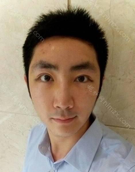 四川省科学城医院整形科门大伟做激光脱毛怎么样？附医生简介|激光脱毛案例及价格表