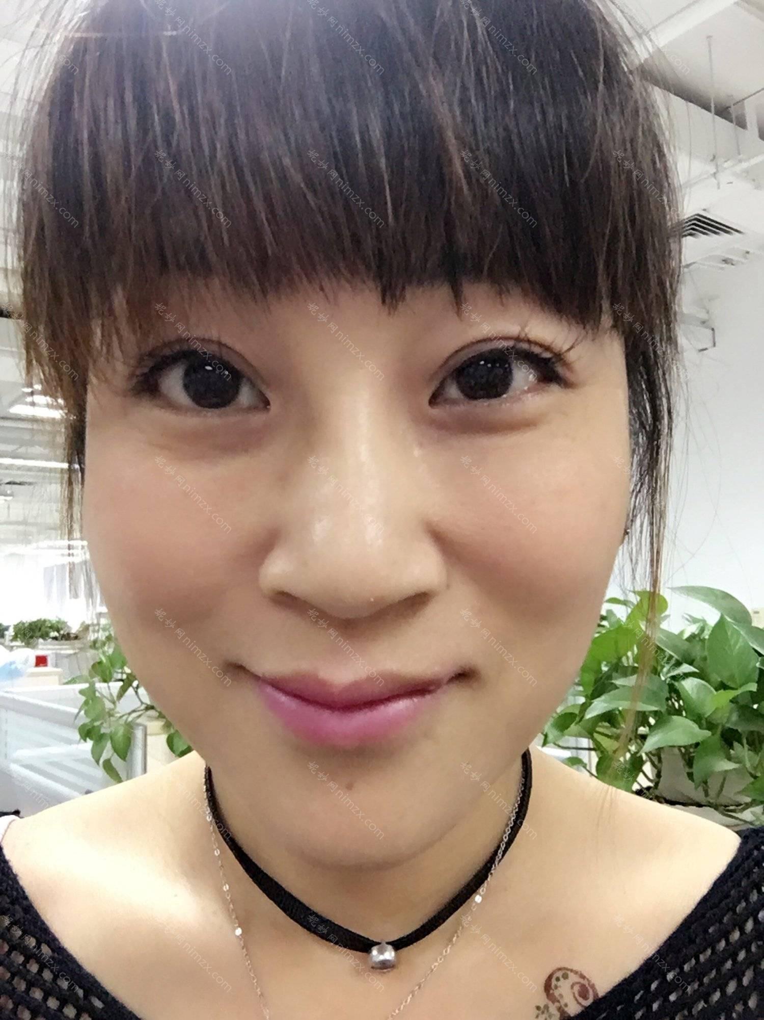 深圳弘美医疗美容玻尿酸丰泪沟医院怎么样？玻尿酸丰泪沟案例+价格价钱全面了解！