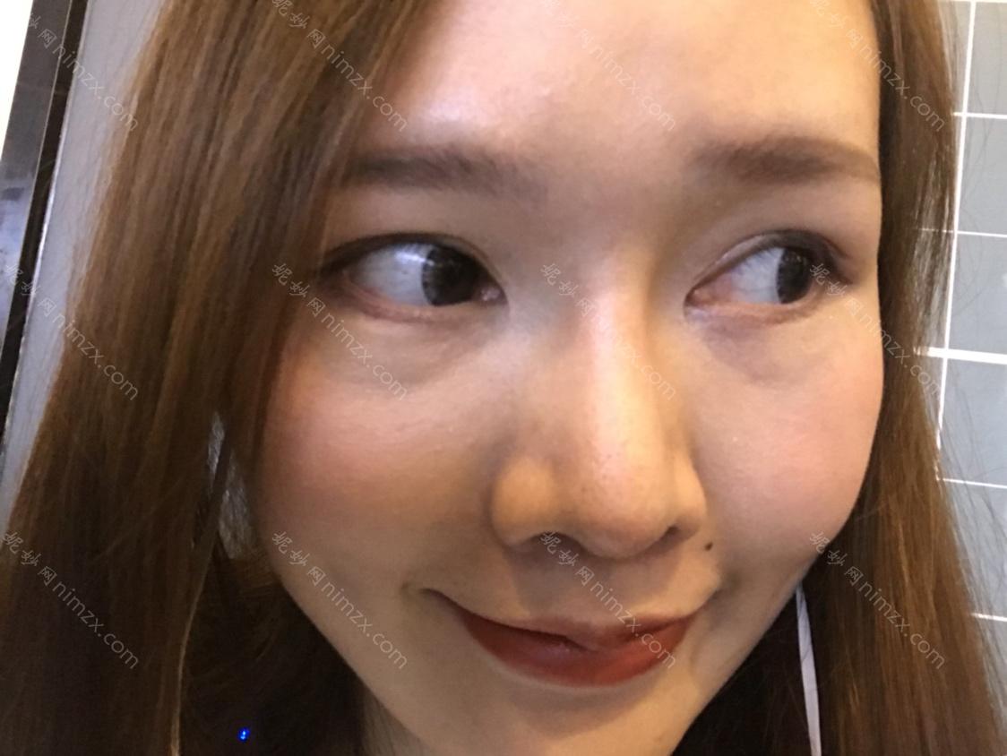 深圳南西子医疗美容玻尿酸填充泪沟口碑怎么样？全新案例对比图及项目价格表曝光