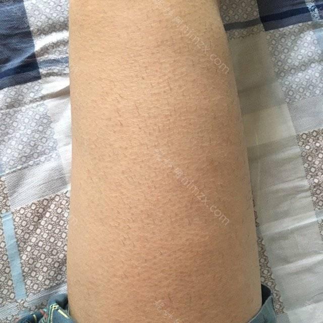 北京炫美医疗美容面部脱毛怎么样？做的面部脱毛30天效果对比！内部价格标准一览