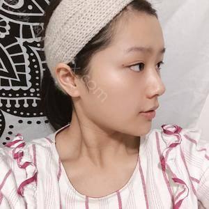 江门市皮肤医院整形美容中心玻尿酸面部填充靠谱吗？玻尿酸面部填充整形案例（图）过程分享~
