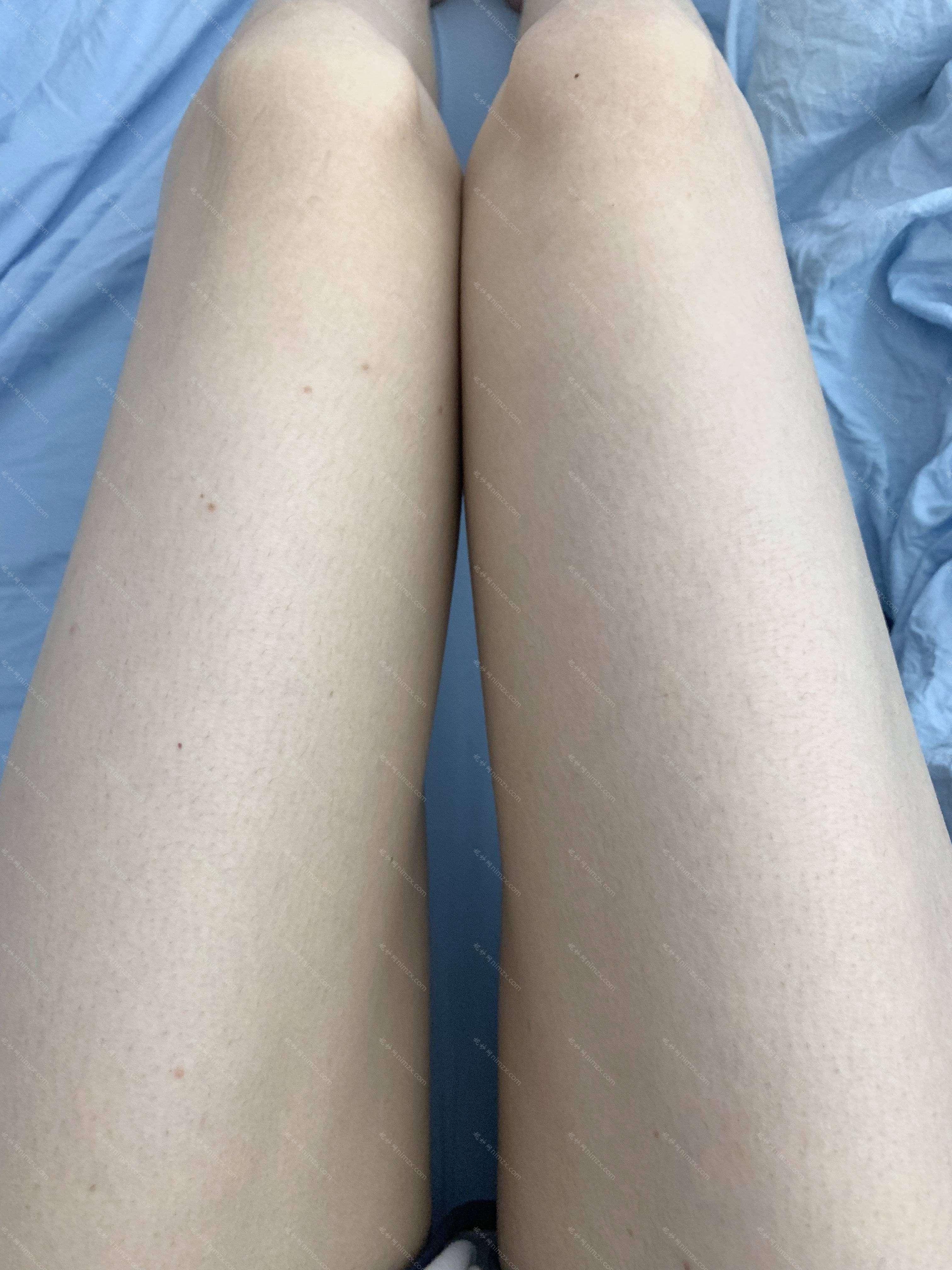 温州加美美容医院激光脱毛医院怎么样？价格、案例同步一览，附带激光脱毛效果和价格收费！