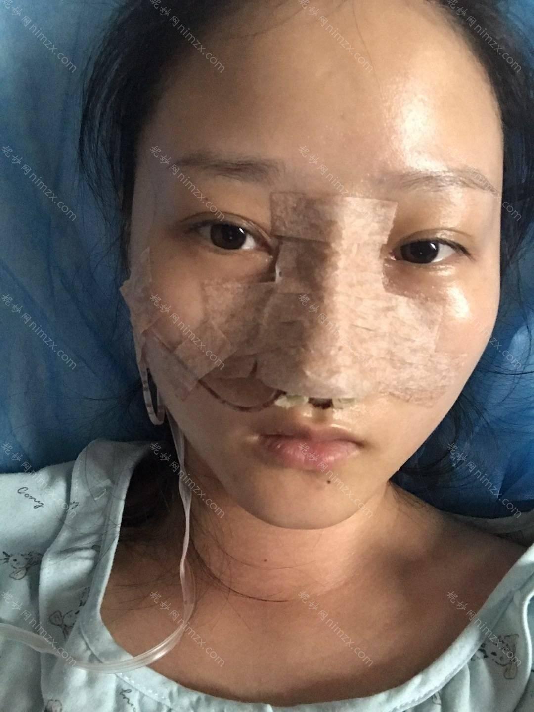 脱毛做得怎么样？手术恢复效果图一览