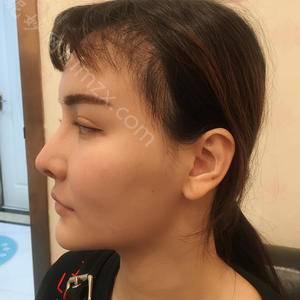 通化哪家医院做鼻中隔软骨隆鼻好看？汇总一份口碑医院排行榜前五点评!价格表全新查询！