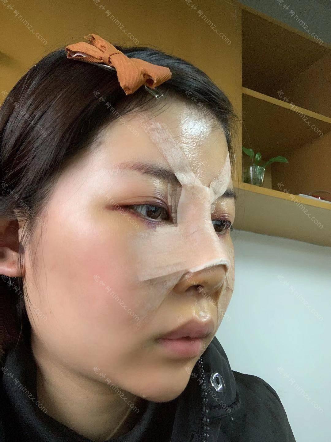 聊城哪家医院做假体隆鼻靠谱？光明、聊城市中医院、莘县中医院等实力在线比较!！