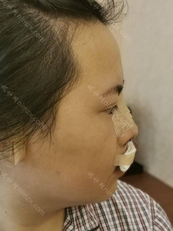 聊城哪家医院做假体隆鼻靠谱？光明、聊城市中医院、莘县中医院等实力在线比较!！