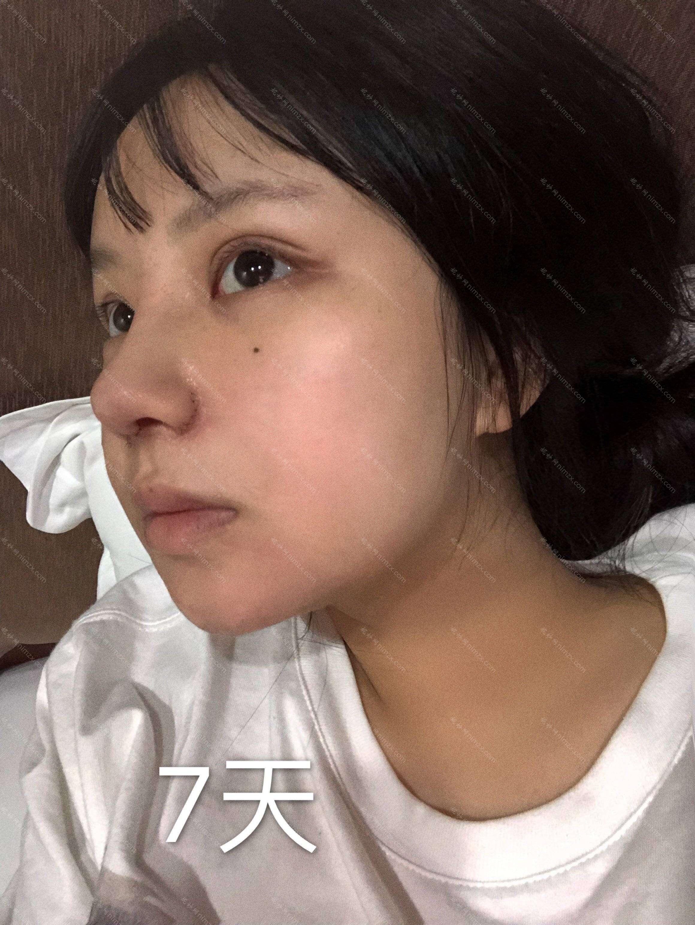 通化哪家医院做玻尿酸隆鼻较好？2021排行榜前五这几家都有资质_含晶晶医学、通化市中心医院等医院！