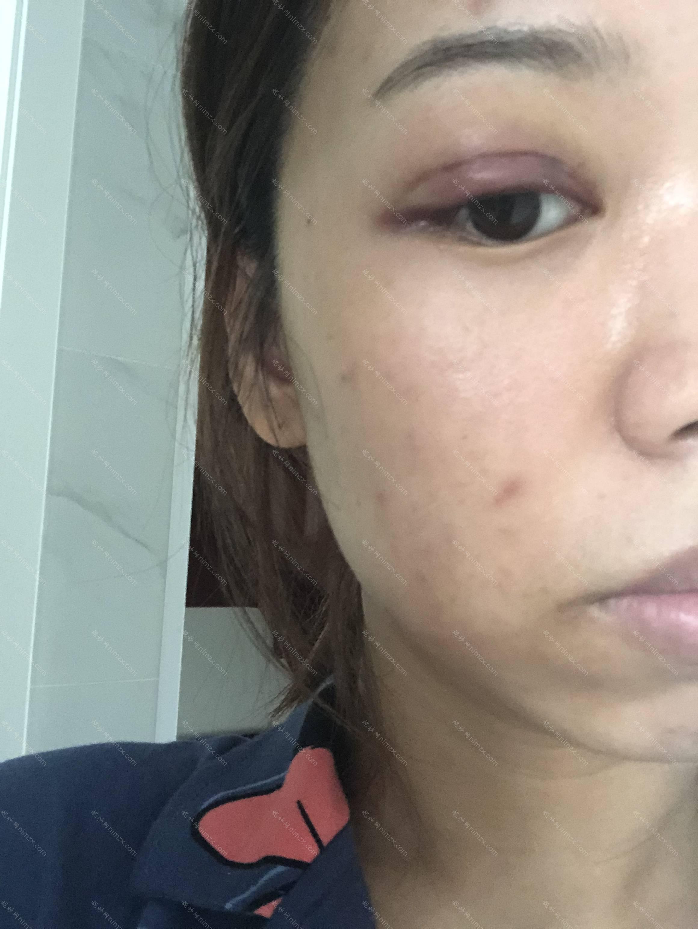 许昌哪家医院做定点双眼皮好？排名前四权威医美口碑盘点_含手术价格查询！