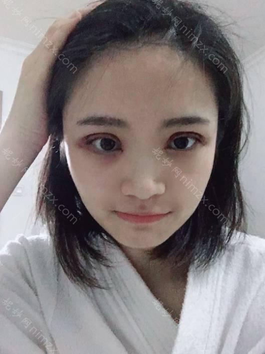 十堰哪家医院做欧式双眼皮正规？正规排名榜盘点前四_价格清单一一出示!！