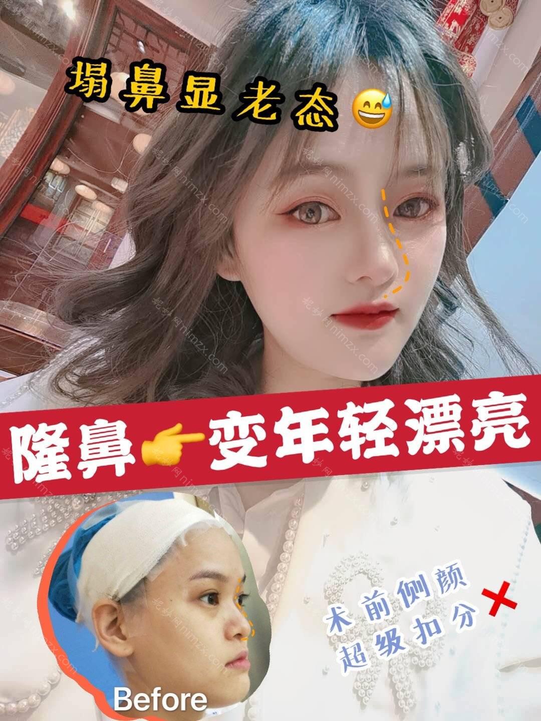 巴中哪家医院做耳软骨垫鼻尖效果比价好？正规排名榜盘点前四_价格清单一一出示!！